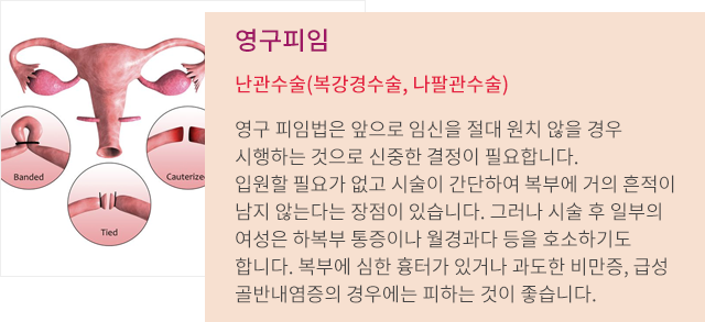 영구임신