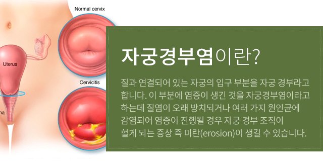자궁경부염이란?