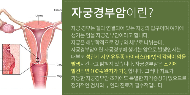 자궁경부암이란?
