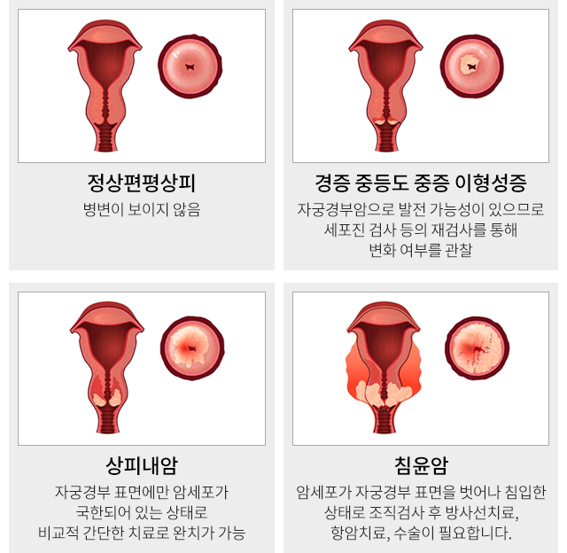 정상편평상피 / 경증 중등도 중증이형성증 / 상피내암 / 침윤암