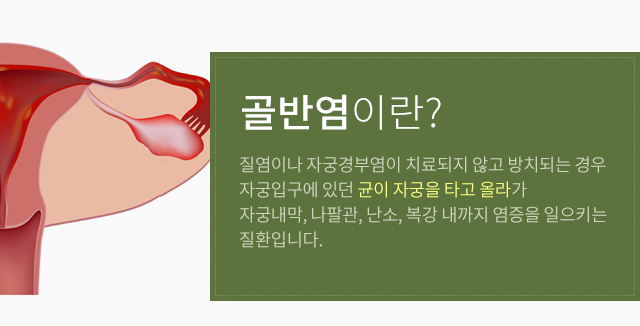 골반염이란?