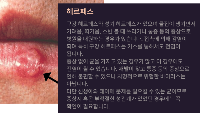 헤르페스