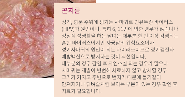 곤지름