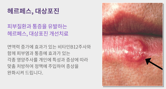 헤르페스, 대상포진